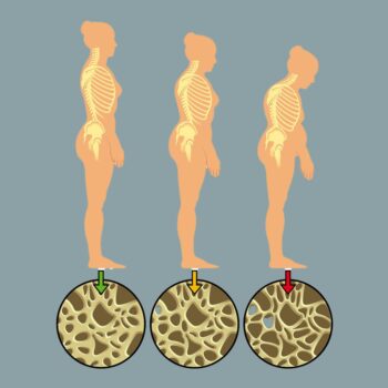 Illustrative Darstellung der Progression von Osteoporose in menschlichen Silhouetten